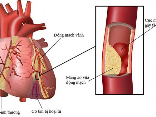 Rối loạn chuyển hóa lipid máu, nên ăn gì?